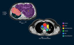 A Right-Sided Heart, A 3kg Tumour: A Rare Surgery at Zydus Hospital, Ahmedabad Gives An 11-Year-Old a New Life tumour A Right-Sided Heart, A 3kg Tumour: A Rare Surgery at Zydus Hospital, Ahmedabad Gives An 11-Year-Old a New Life Image for PR 150x92