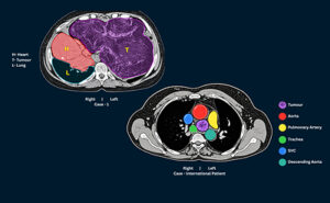 A Right-Sided Heart, A 3kg Tumour: A Rare Surgery at Zydus Hospital, Ahmedabad Gives An 11-Year-Old a New Life tumour A Right-Sided Heart, A 3kg Tumour: A Rare Surgery at Zydus Hospital, Ahmedabad Gives An 11-Year-Old a New Life Image for PR 300x185