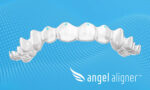 Paris Court Ruling on Discontinued Feature Will Have Minimal Impact on Angelalign Customers  Paris Court Ruling on Discontinued Feature Will Have Minimal Impact on Angelalign Customers Angelalign Technology Inc Angelalign Has Already R 150x90