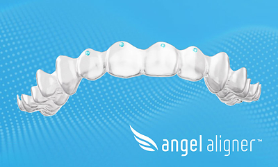 Paris Court Ruling on Discontinued Feature Will Have Minimal Impact on Angelalign Customers  Paris Court Ruling on Discontinued Feature Will Have Minimal Impact on Angelalign Customers Angelalign Technology Inc Angelalign Has Already R