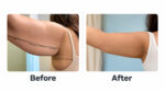 Zydus Hospitals, Ahmedabad, Takes Post-Weight-Loss Transformation Beyond the Scale  Zydus Hospitals, Ahmedabad, Takes Post-Weight-Loss Transformation Beyond the Scale before after surgery comparision 150x84